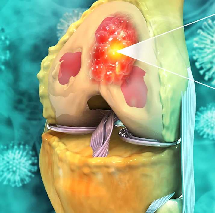 耶鲁大学医学院分享：MR如何革新骨癌手术
